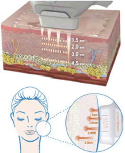 HIFU laser facial treatment infographic