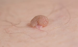 Pedunculated skin tag or acrochondon or soft fibroma. Papilloma bump on male body macro shot. Fibroepithelial polyp on stalk. Benign epidermis lesion close up.