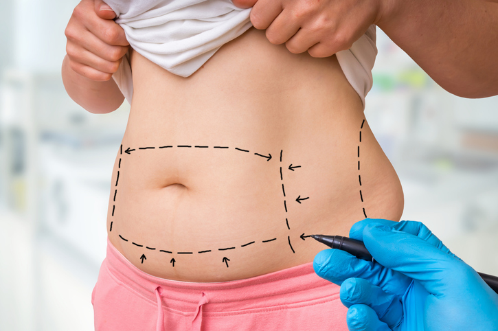 doctor drawing on woman's belly in preparation for liposuction surgery