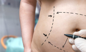 doctor preparing belly for liposuction
