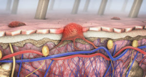 skin cancer illustration