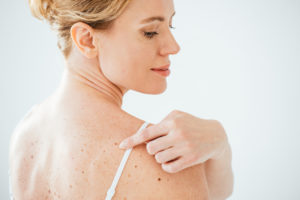 moles and skin cancer