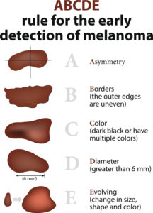check for melanoma infographic