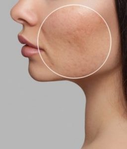 acne scarring during menopause