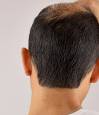 hair loss treatments