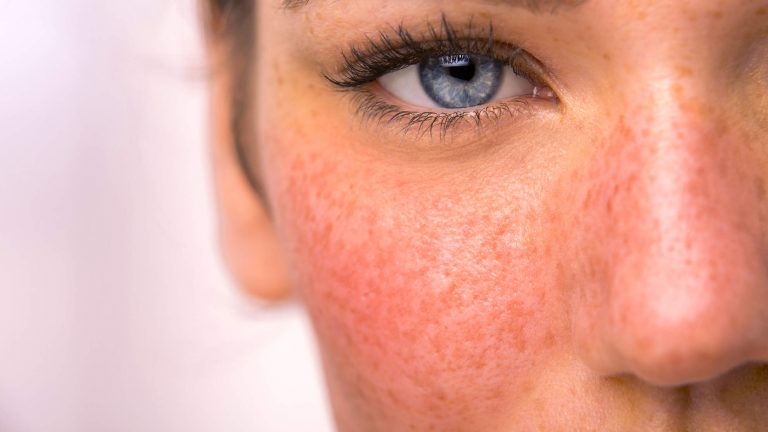 rosacea treatments