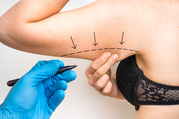 liposuction under arm preparation with doctor