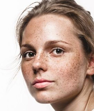 freckles and age or sunspots