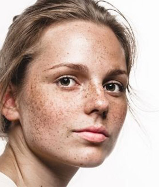 girl with lots of freckles