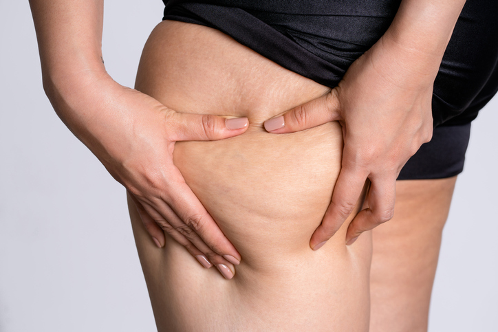 Cellulite Removal Treatment  Victoria's Cosmetic Medical Clinic