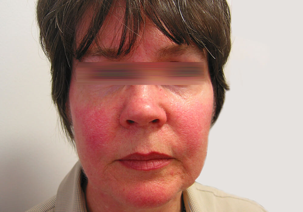 Rosacea Treatment in Melbourne - ENRICH Clinic