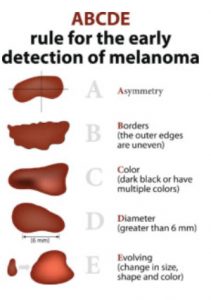 early detection of melanoma infographic