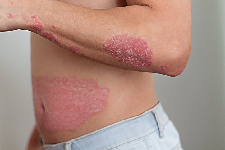 psoriasis skin on arm and abdomen