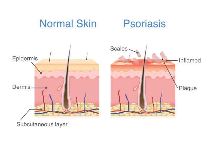 psoriasis skin info graphic