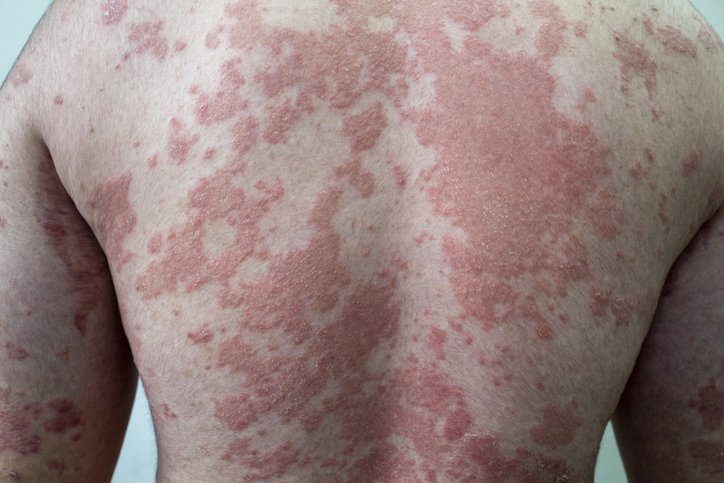 psoriasis on back
