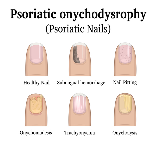 nail psoriasis types