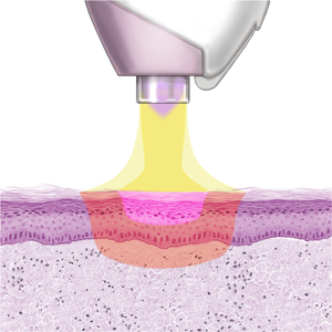 device transferring nitrogen plasma energy to the skin infographic