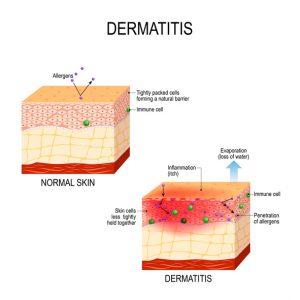 dermatitis infographic - normal skin vs dermatitis