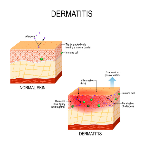 What is dermatitis & how is it related to psoriasis? | ENRICH Clinic