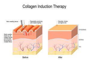 collagen induction therapy infographic - before and after