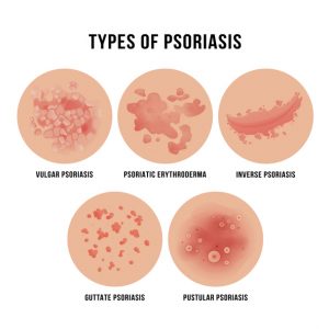 different types of psoriasis infographic