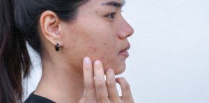 adult woman with acne on cheeks and jawline