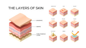 layers of skin infographic