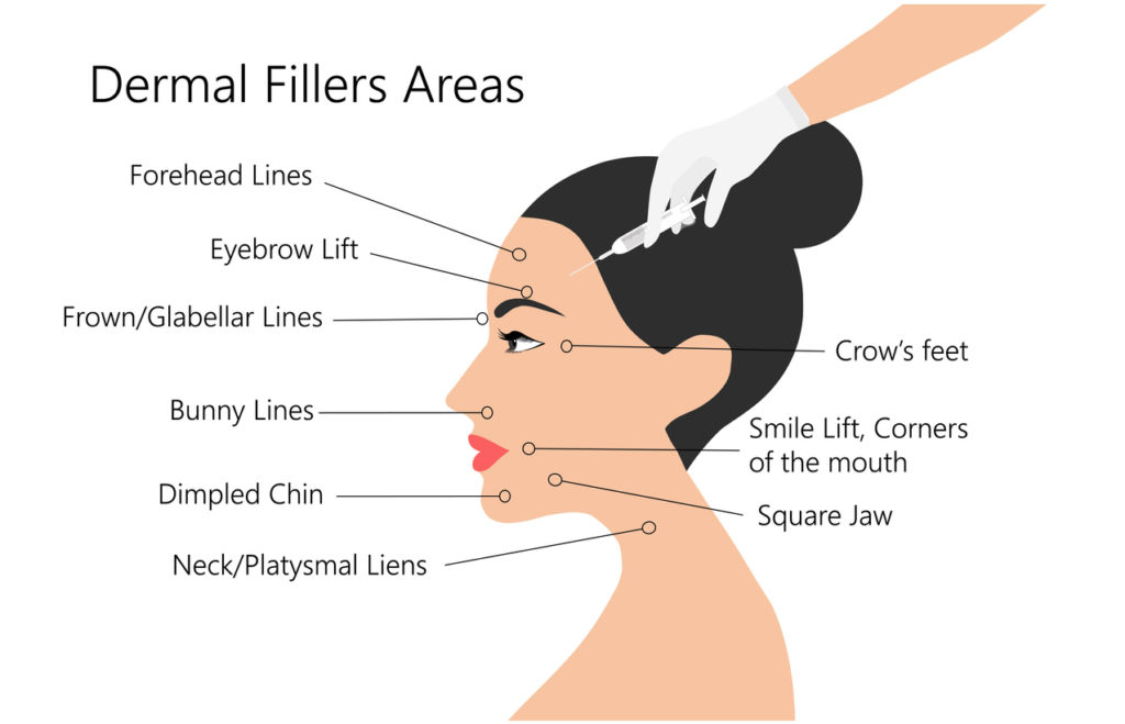 infographic of common areas for dermal filler treatment
