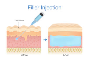 dermal filler injection into skin before after infographic