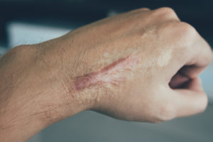 keloid scar - raised scar on hand