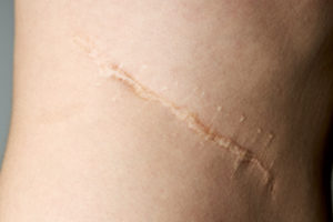 surgical scar