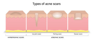 Types of acne scars - Hypertrophic scars and Atrophic scars infographic