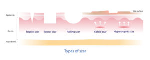 Types of scar vector, icepick scar, boxcar scar, rolling scar, keloid scar and hypertrophic scar infographic