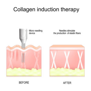 collagen induction therapy diagram