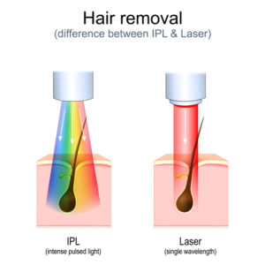 IPL vs laser hair removal