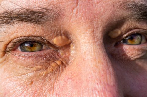 close-up of a man's eyes with fat accumulations, Xanthelasmas