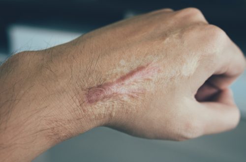 scar on hand